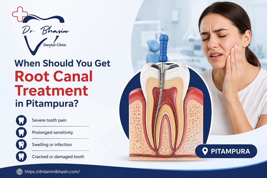 When Should You Get Root Canal Treatment in Pitampura