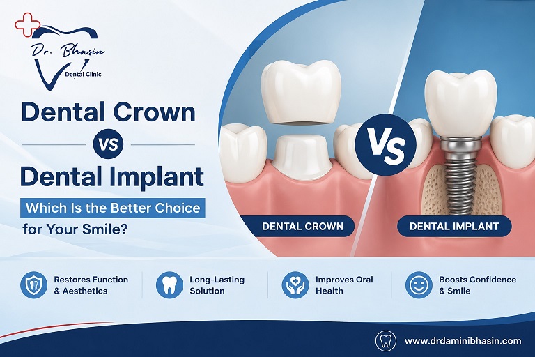 Dental Crown vs Dental Implant: Which Is the Better